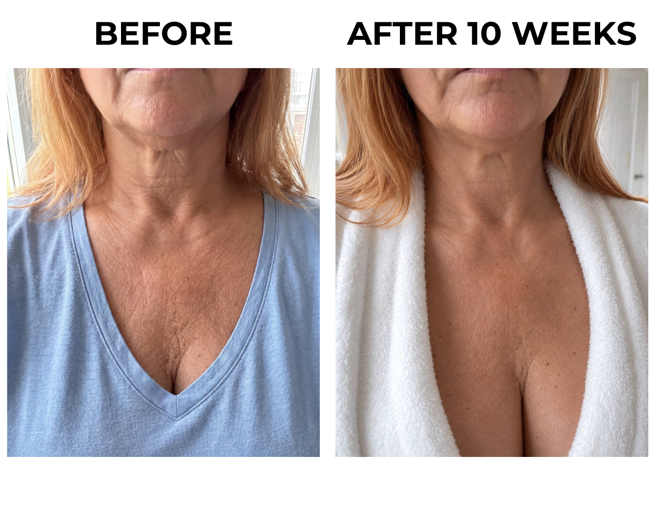 Neck and chest skin at week ten