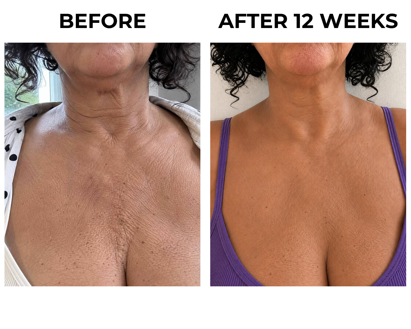 Neck and chest skin at week twelve
